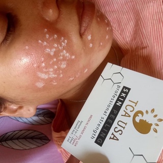 MỸ PHẨM PEEL TCA CHẤM NÁM, RO, TÀN NHANG, ĐỒI MOI..