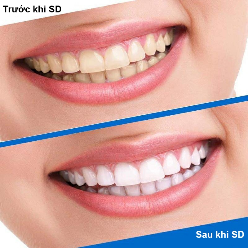 Miếng dán trắng răng tiện lợi 3D White Teeth Whitening Strips gồm 14 miếng dán 7 gói