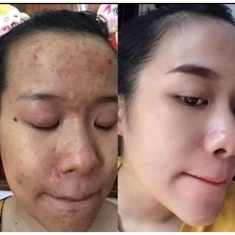 50ml Cao lá nam chuyên mụn , dưỡng trắng da không sưng , không bong chóc da handmade