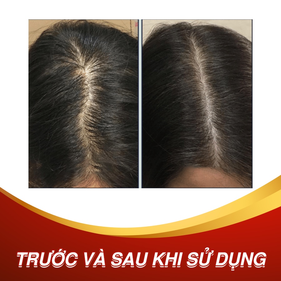 Viên uống mọc tóc Hairtonic, giảm rụng tóc, kích thích tóc mọc nhanh, chắc khỏe, suôn mượt (100 viên)