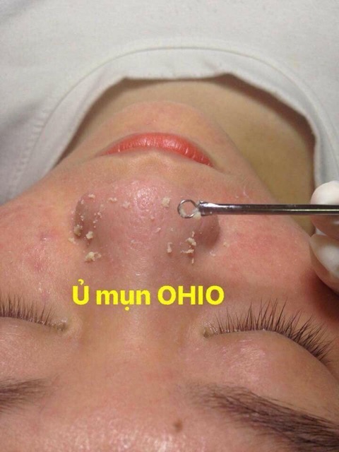 Ủ Mụn OHIO Hàn Quốc