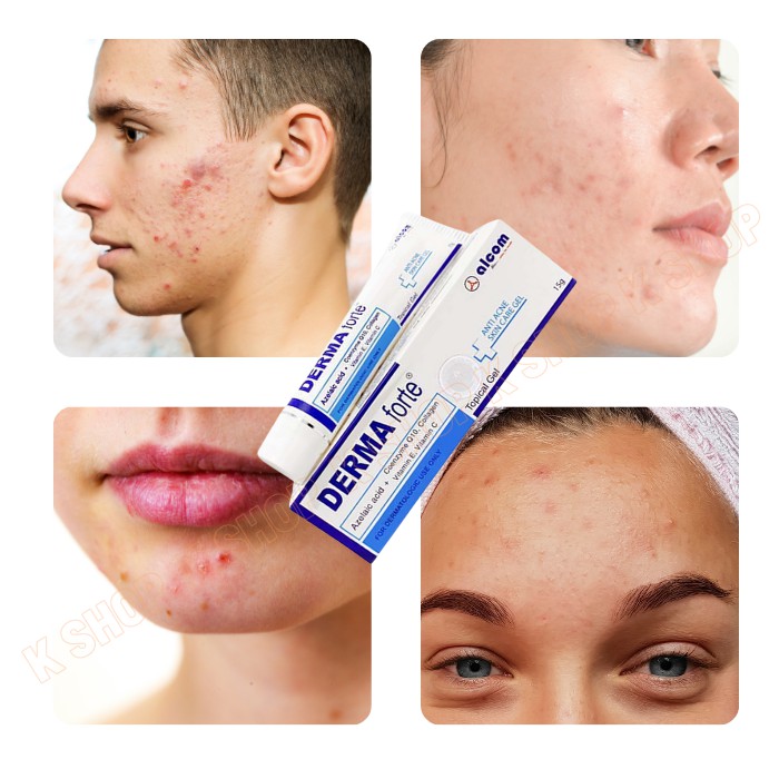 Gel MỤN Derma Forte giúp ngăn ngừa và giảm loại mụn trứng cá, mụn đầu đen, mụn đầu trắng mờ thâm liền sẹo | BigBuy360 - bigbuy360.vn
