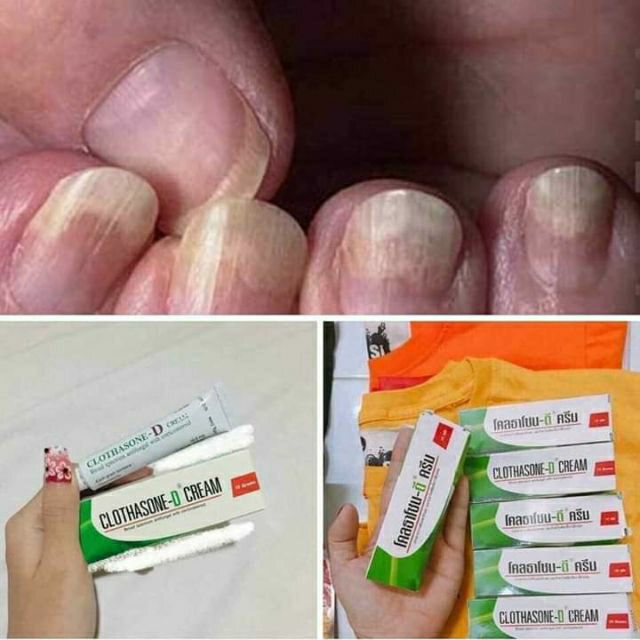 TRỊ NẤM MÓNG TAY CHÂN THAILAND