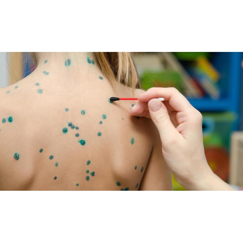 Combo bôi da bỏng do kiến ba khoang - Dung dịch hồ nước và nước xanh Methylen 1%