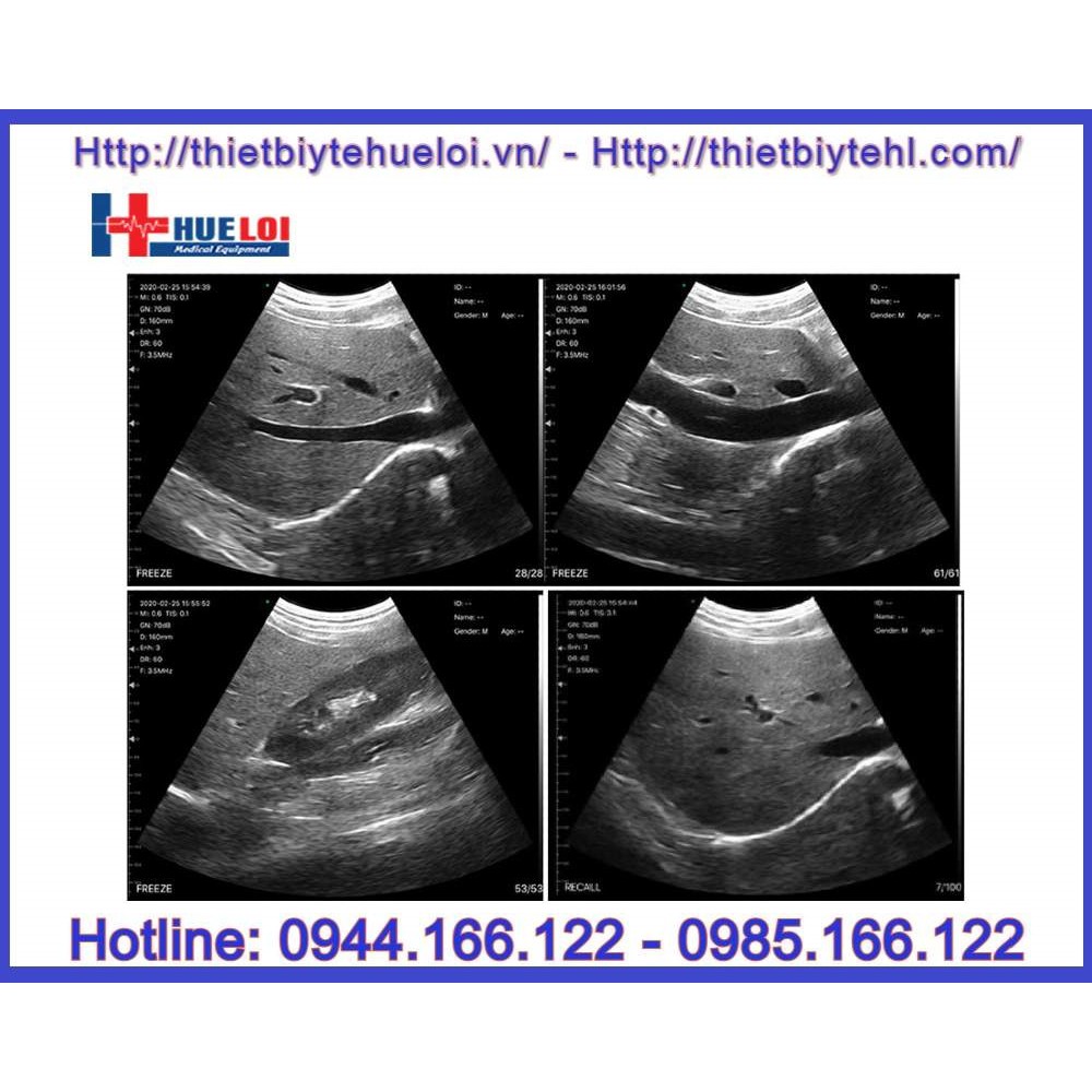Đầu dò siêu âm Convex kết nối điện thoại không dây _ Thiết bị y tế Huê Lợi