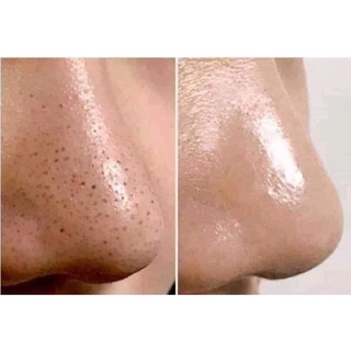 GEL HÚT MỤN DR.ACNE