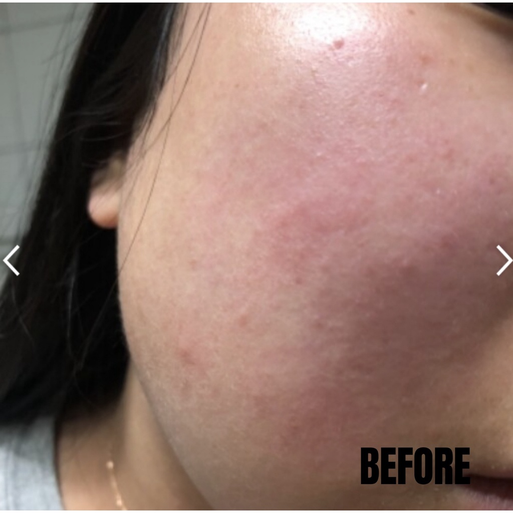 Serum hoa hồng giảm thâm ISOI BLEMISH CARE SERUM 20ml (Hàng tách set)