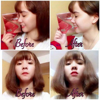 Sụn Nâng Mũi
