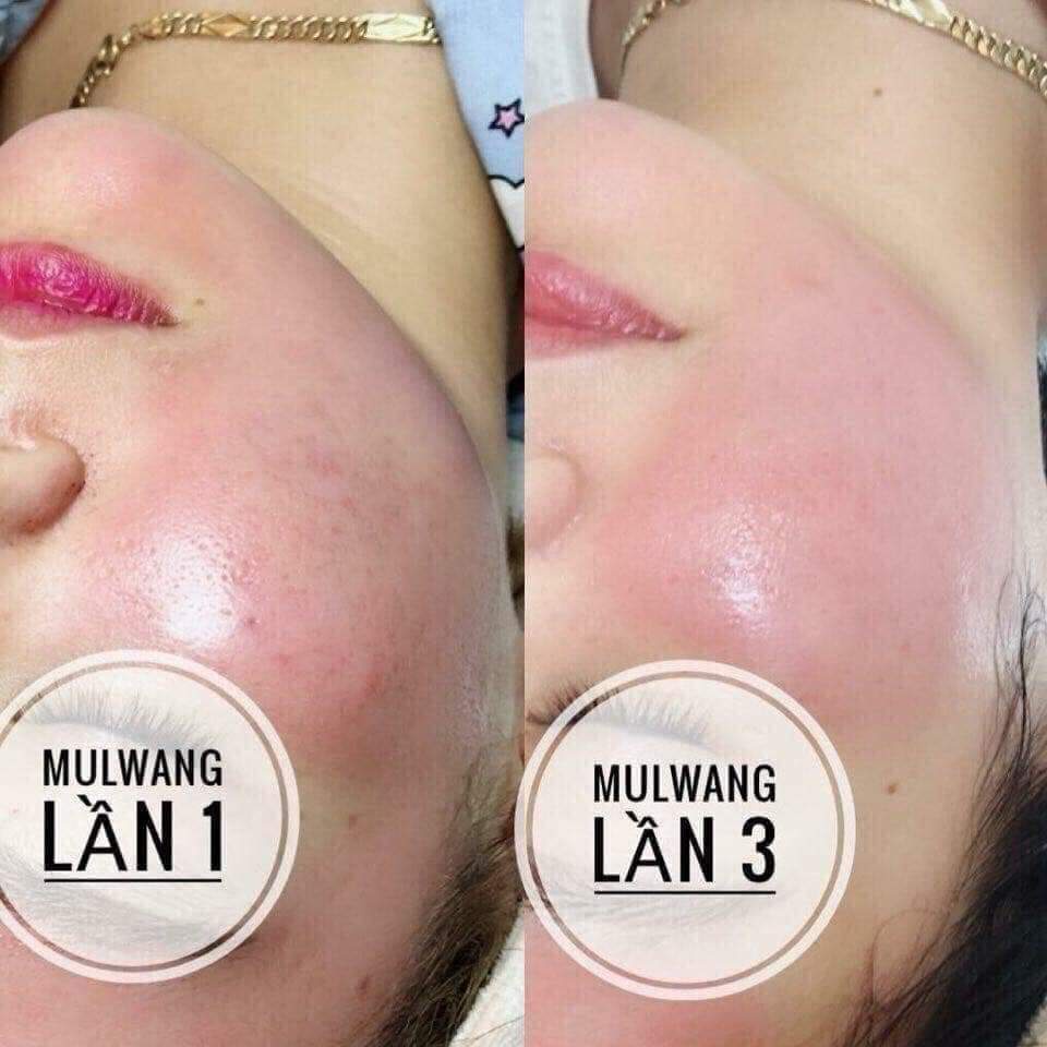 Mulwang x5 căng bóng da Hàn Quốc - Hàng chính hãng