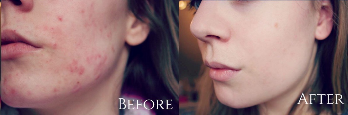 Gel bôi mụn Lush Grease Lightning lành tính, giảm đỏ, viêm, gom khô cồi mụn | BigBuy360 - bigbuy360.vn