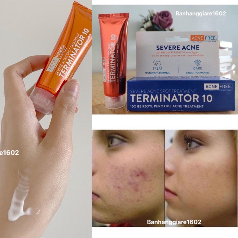 Kem Chấm Mụn AcneFree Terminator 10 Acne Spot Treatment with 10% Maximum Strength Benzoyl Peroxide (bill Mỹ)