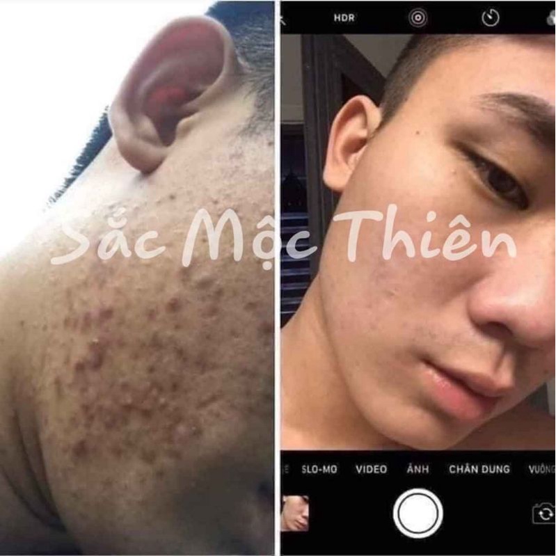 Tái tạo da cao cấp Sắc Mộc Thiên- Hỗ trợ cải thiện mụn- Nám- Tàn nhang- Sẹo | BigBuy360 - bigbuy360.vn