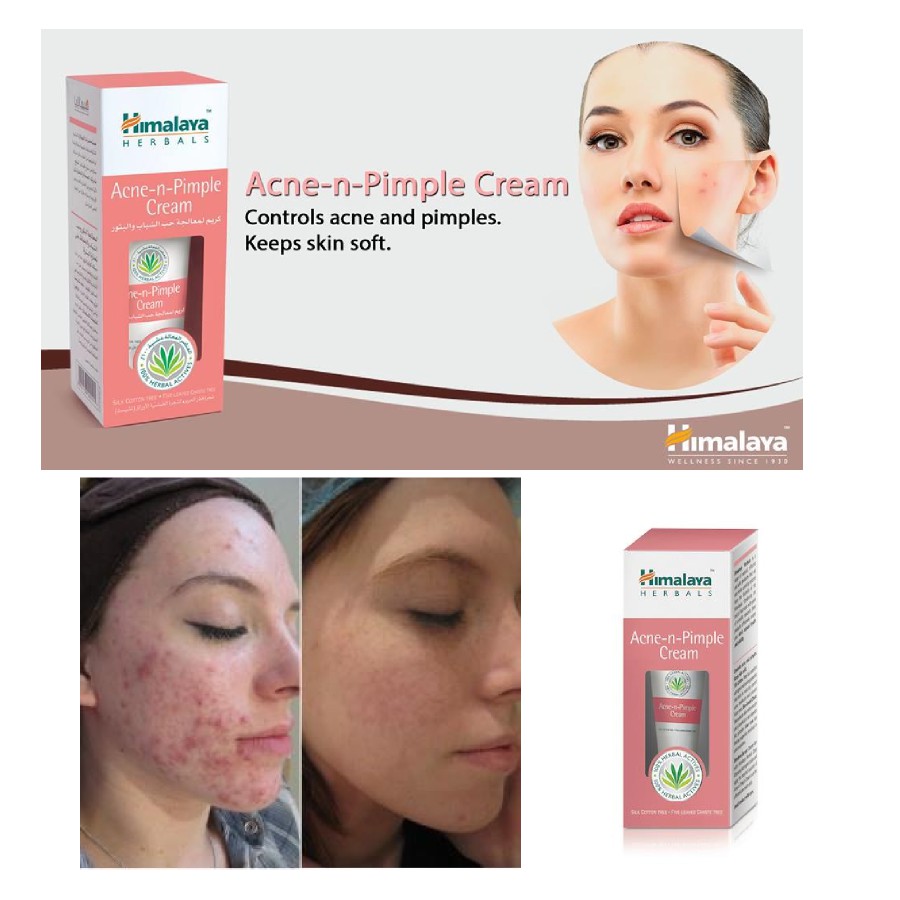 Kem chấm mụn giảm thâm sạch mụn Himalaya Acne-n-Pimple Cream 30g | BigBuy360 - bigbuy360.vn