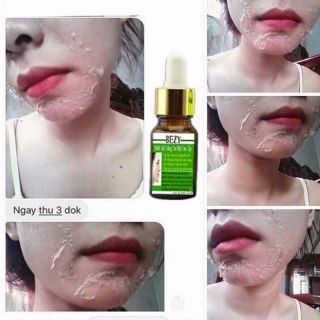 COMBO KEM LỘT TRẮNG DA NÁM