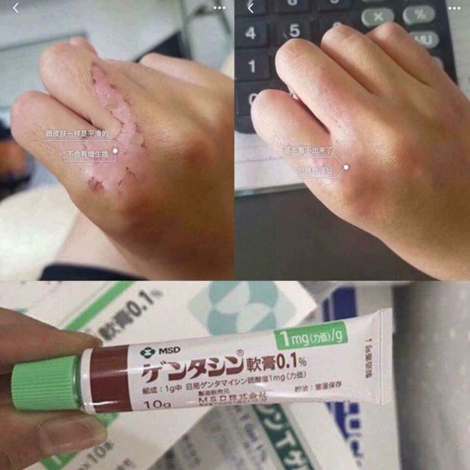 Kem Giảm sẹo Gentacin Nhật Bản 10g ( Takata Gentamicine )