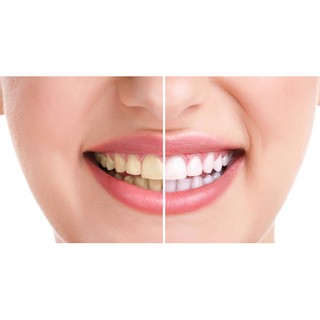 Bột tẩy trắng răng Eucryl