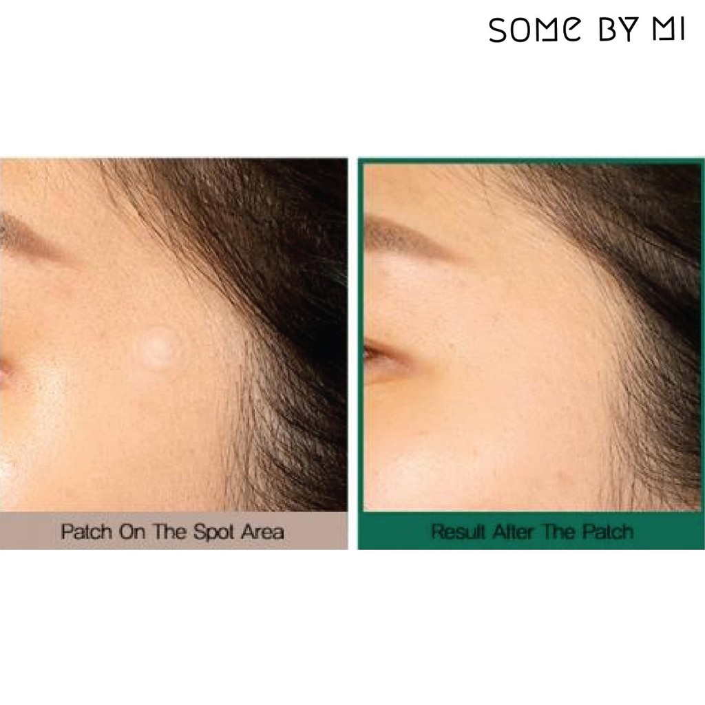 Some By Mi - Miếng Dán Mụn Some By Mi 18 Miếng Clear Spot Patch