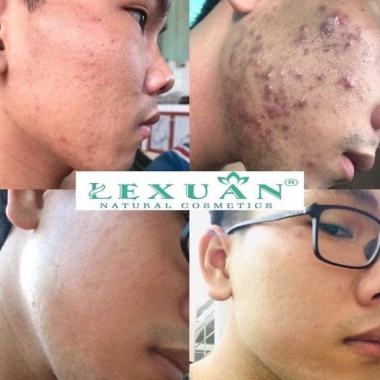 Tinh chất mụn Lê Xuân handmade 130ml | BigBuy360 - bigbuy360.vn