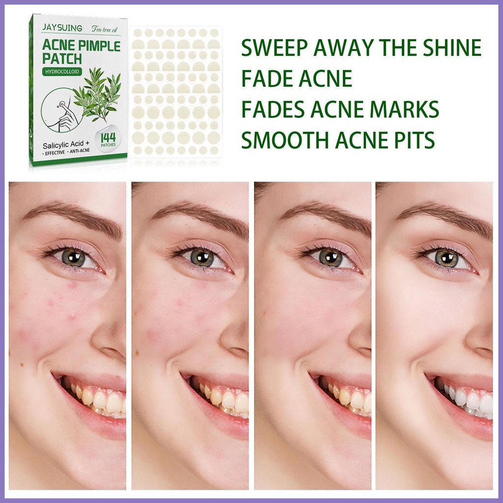 Miếng Dán Trị Mụn Vô Hình 144 Miếng nota2vn