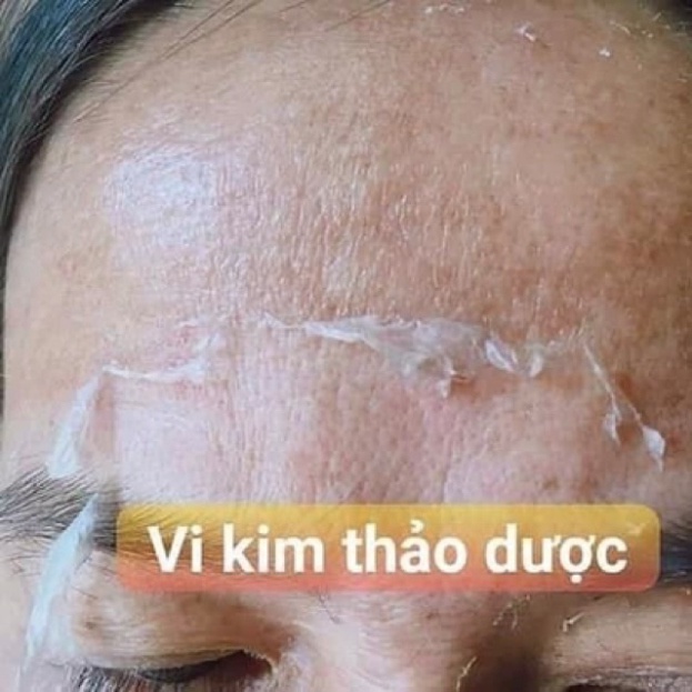 Vi Kim Thảo Dược Thay Da Sinh Học Hiệu Quả Chính Hãng 100%