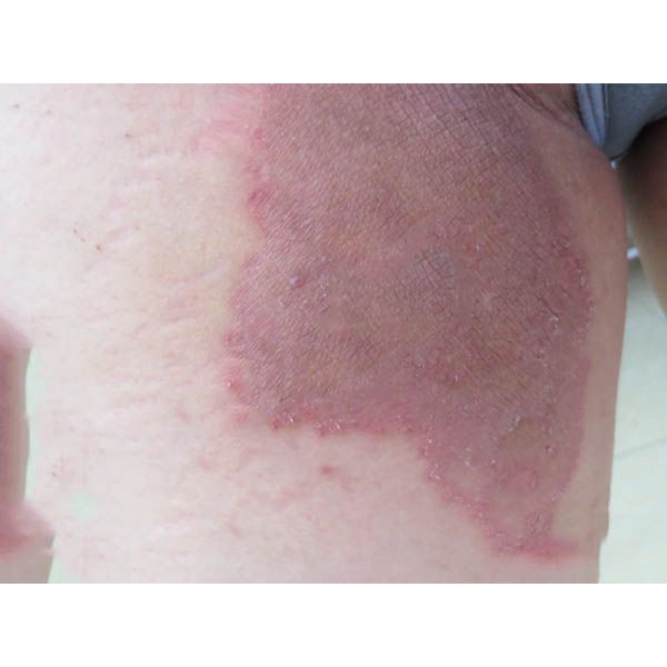 Thảo dược Hết Ngay Nấm ngứa, Nấm hình tròn, Nấm đồng xu, Hắc lào Háng, Bụng, Đùi, Mông