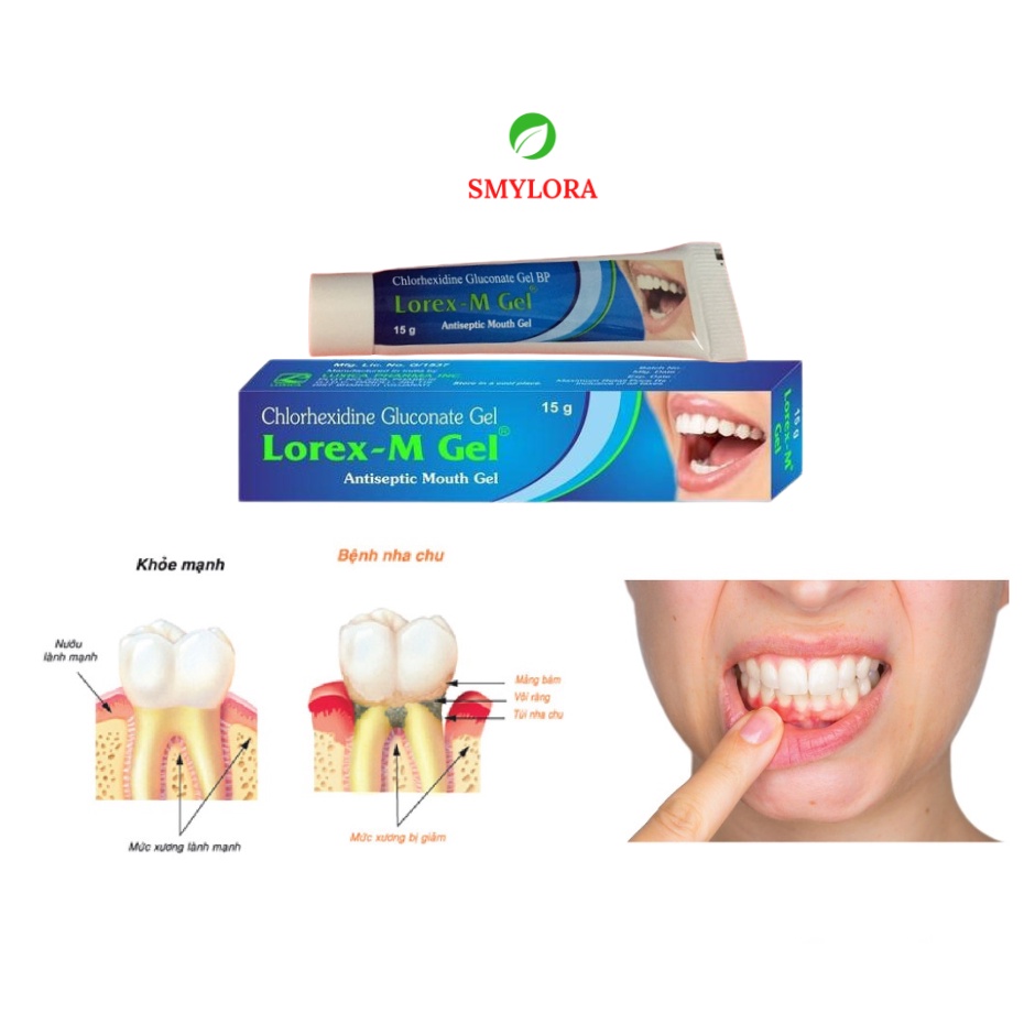 Gel Bôi Viêm Lợi LOREX-GEL,SMYLORA-GEL Giảm Và Ngăn Ngừa Các Tác Nhân Gây Nhiệt Miệng,Viêm Lợi,Viêm Chân Răng,Hôi Miệng