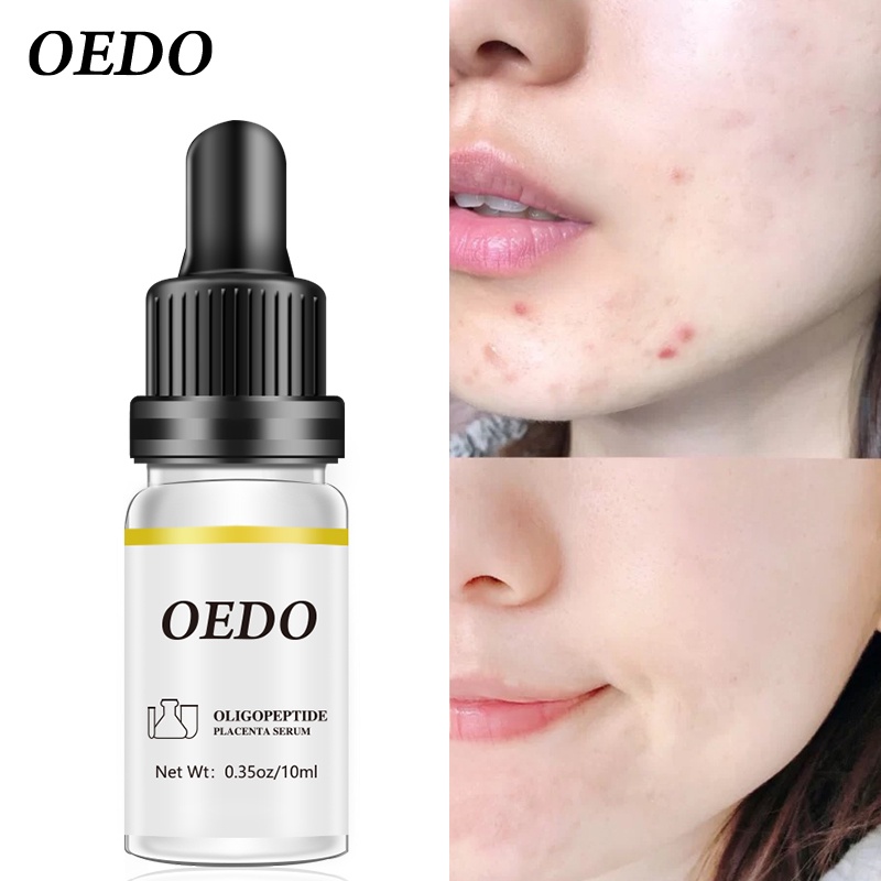 OEDO Serum dưỡng da Oligopeptide Placenta Ẩm Làm Trắng Da Chống Lão Hóa Chống Nhăn Dưỡng Ẩm Sâu nếp nhăn 10ml