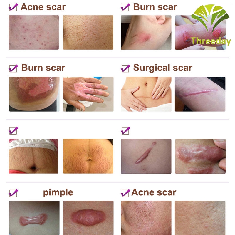 3D❤ Scar Removal Cream Lavender Cream Skin Care Natural Remove Burn Stretch Marks Ointment