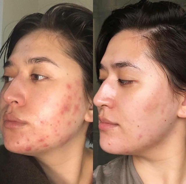 CICAPLAST B5 GEL - “THẦN DƯỢC” PHỤC HỒI THÂM MỤN, SẸO MỤN La roche posay
