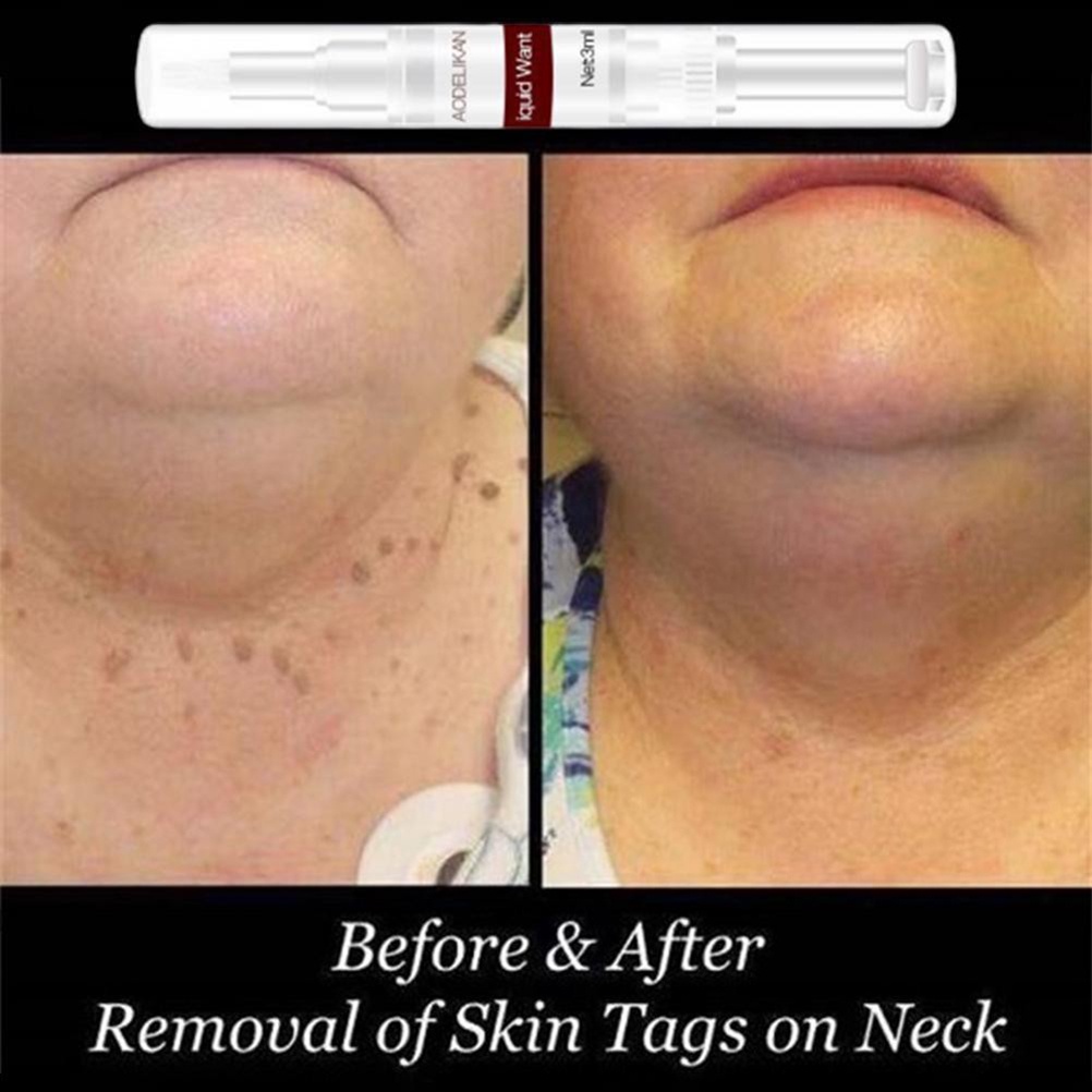 (Hàng Mới Về) Dung Dịch Loại Bỏ Mụn Thịt Nhanh Chóng 3ml | BigBuy360 - bigbuy360.vn