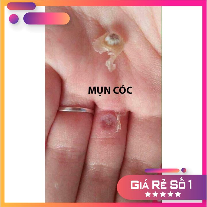 Dung dịch diệt mụn cơm, mụn cóc, sạn cá, mụn thịt của nga, sẵn hàng