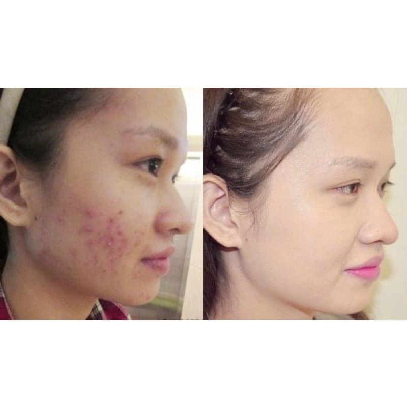 Thảo dựợc tái tạo da chuyên mụn , nám , tàn nhang , se khít lỗ chân lông , trắng da handmade