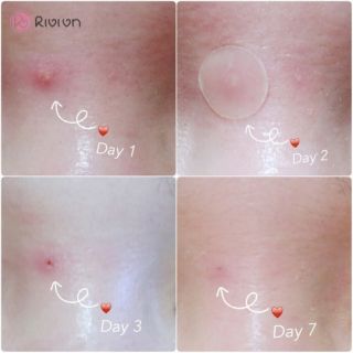 [Duty Hàn] Miếng Dán Mụn Cosrx Clear Fit Master Patch 18 Miếng