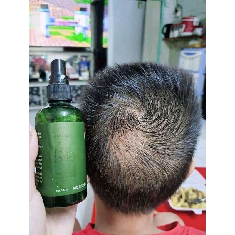 [ CHÍNH HÃNG ] Tinh dầu bưởi VIJULLY giúp mọc tóc nhanh, giảm rụng tóc, dùng được cho nam và nữ sản phẩm 100% thiên nhiê | BigBuy360 - bigbuy360.vn