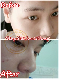 [ HÀNG CAO CẤP ] Tinh chất nâng mũi Pháp Miracle