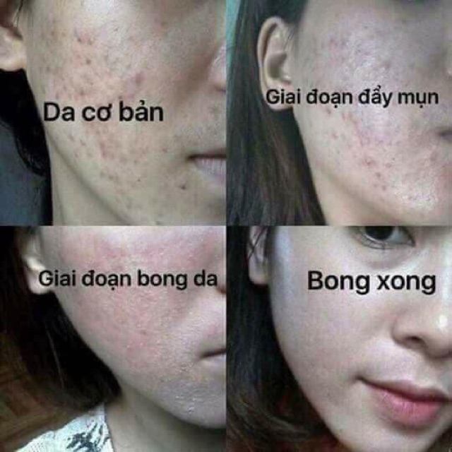 Handmade Thảo dược gia truyền tái tạo da đánh bay mụn, nám, tàn nhang, sẹo rỗ, sẹo thâm Handmade | BigBuy360 - bigbuy360.vn