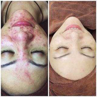 mặt nạ thải độc co2 dj cacbon therapy