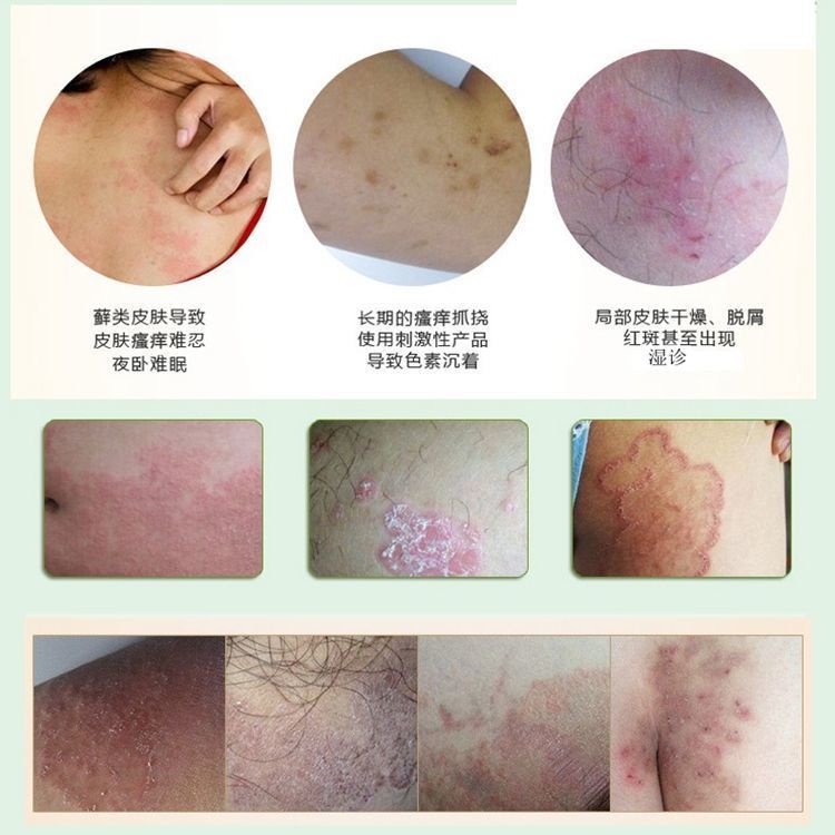 Urticaria, Eczema, Psoriasis, Hands, Feet, Ringworm, Dermatitis, Allergies, Skin Diseases chính