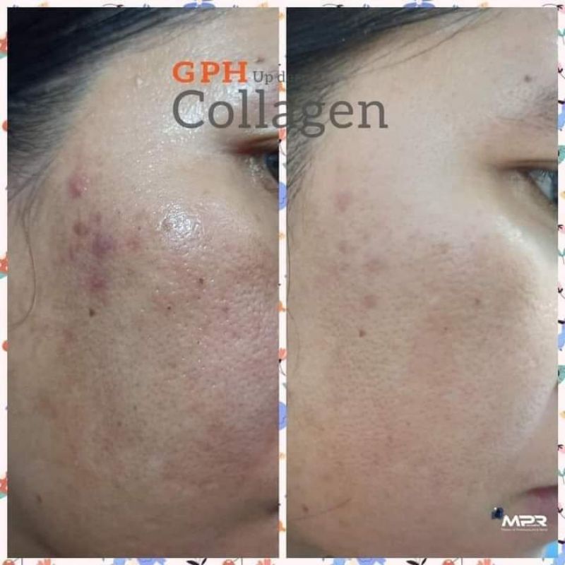 GPH Up Derma COLLAGEN - Collagen thủy phân - Hết khô hạn - Da căng bóng đàn hồi - Tóc chắc mượt - Xương chắc khỏe