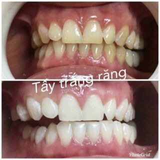 Opalescence thuốc  tẩy trắng