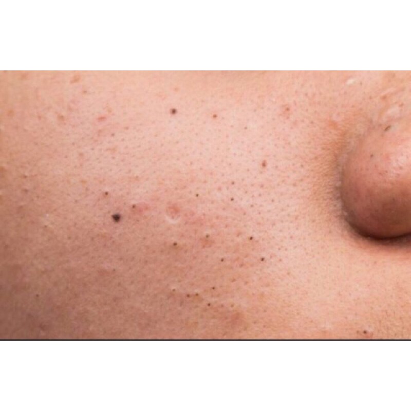 Combo 5 kim lancet nặn mụn chích mủ vô trùng