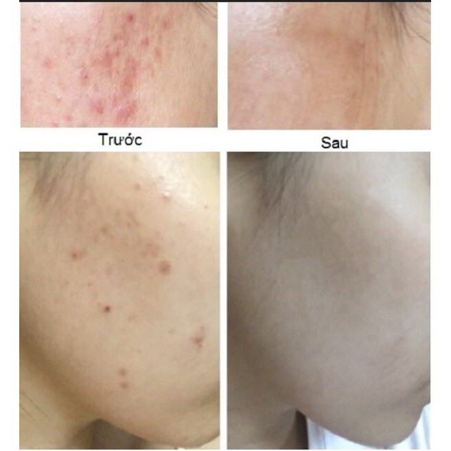 Đầu Lăn Kim 12-24-36-NANO cho Máy Lăn Kim DR PEN