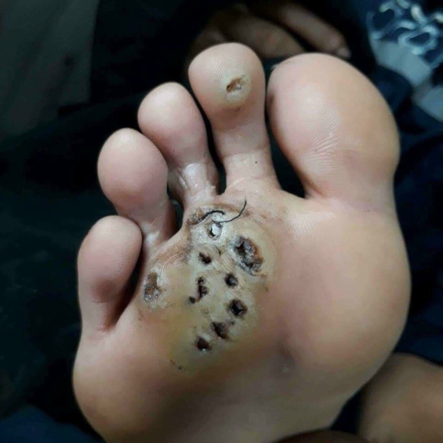 Mụn cơm, mụn cóc, mắt cá