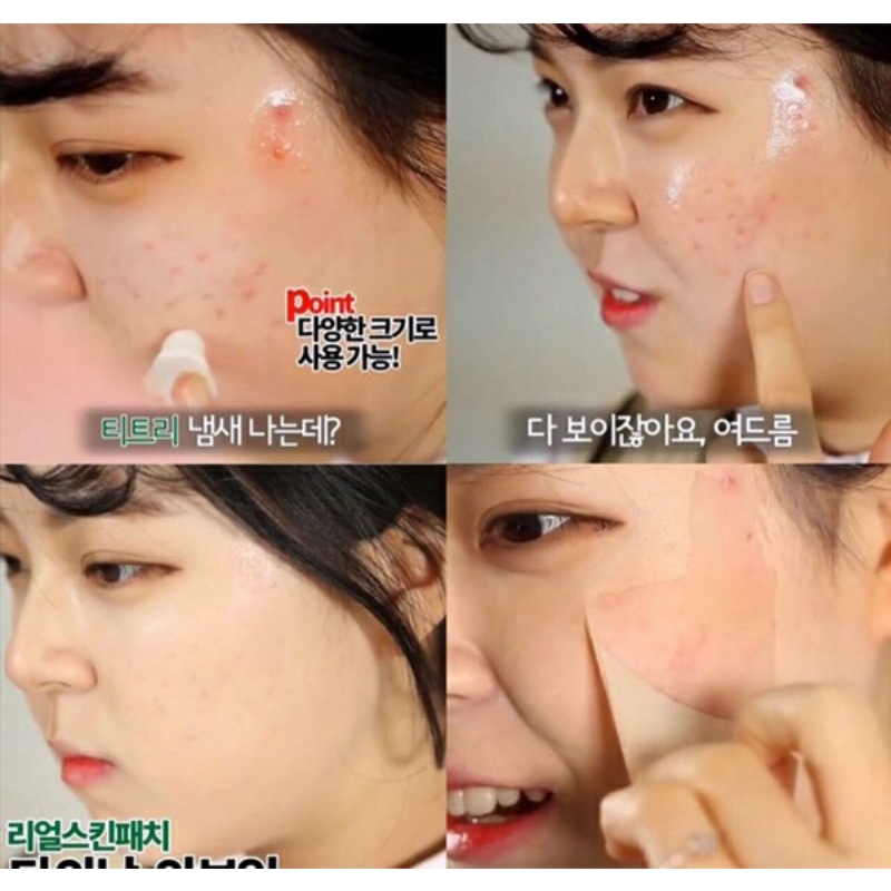 Gel vá da che mụn Real Skin Patch | BigBuy360 - bigbuy360.vn