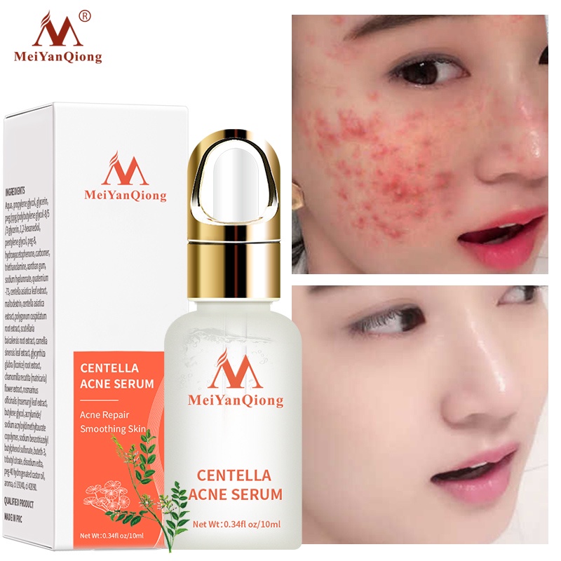 Serum hỗ trợ trị Mụn Trứng Tinh Chất Rau Má MeiYanQiong Kiềm Dầu Và Dưỡng Ẩm 10ml