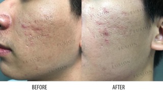 Fusion F-Matrix Tinh Chất Làm Đầy Sẹo Rổ (Cam Kết Chính Hãng)