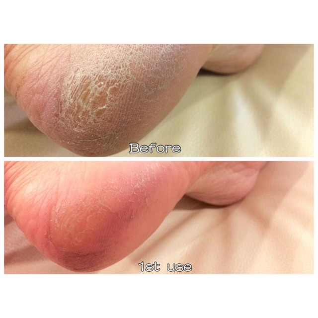 Sole Solution Foot Treatment Nuskin - Kem làm mềm và giảm nứt gót chân Nuskin