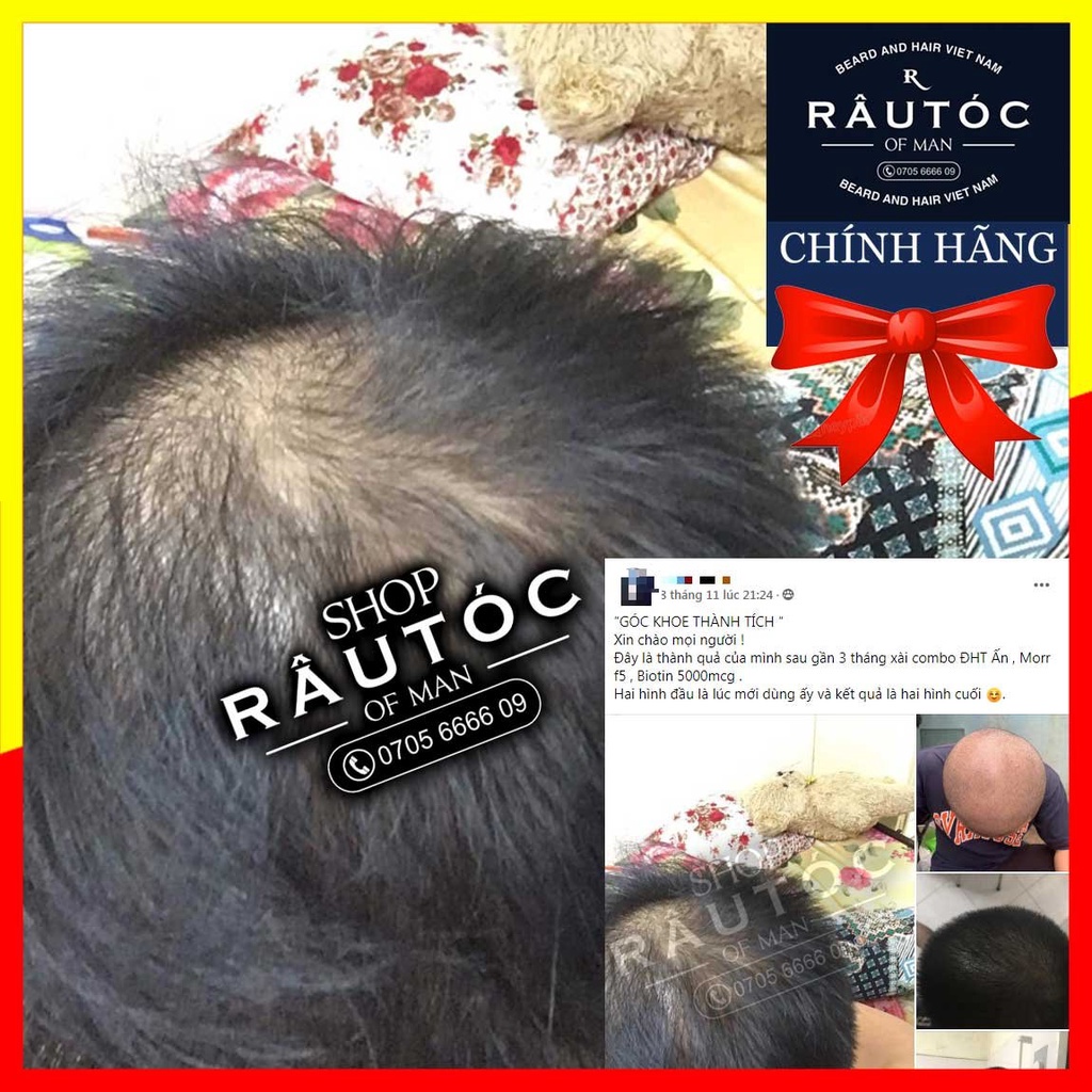 Mọc tóc Hair 4U Pro