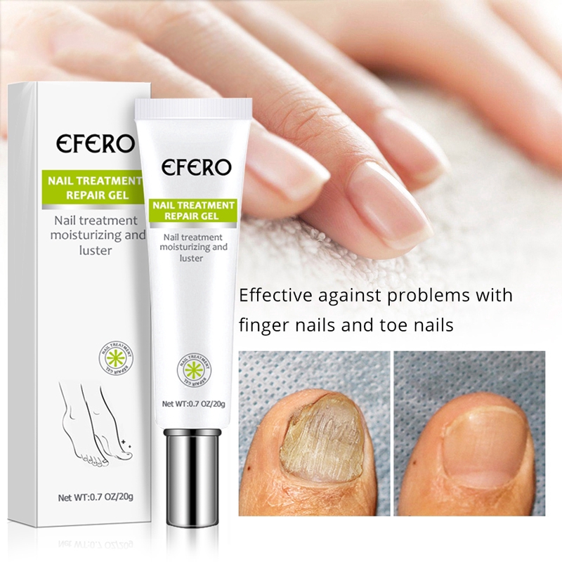[Hàng mới về] Serum dưỡng loại bỏ nấm móng chân móng tay chống nhiễm trùng