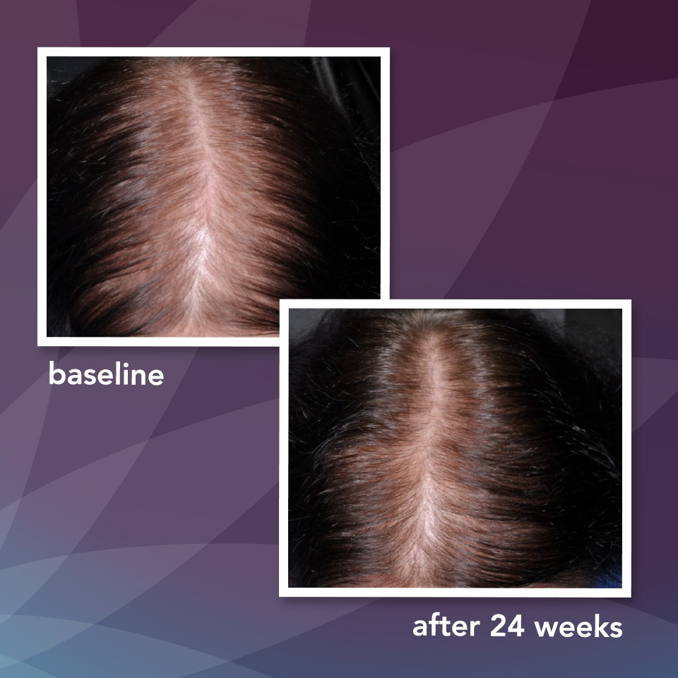 Thuốc mọc tóc dạng bọt Minoxidil 5% Women's  dành cho nữ của Rogaine